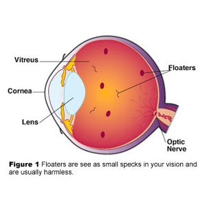 Eye Floaters Directory - WebMD